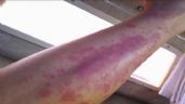 Estados Unidos: Mujer se infecta de bacteria come carne en playa de Golfo de México 