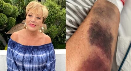 Sylvia Pasquel sufre fuerte accidente, filtran fotos de su estado de salud