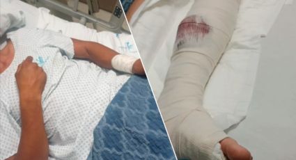 Negligencia médica: Va a clínica para recuperarse de pierna amputada y le fracturan la otra