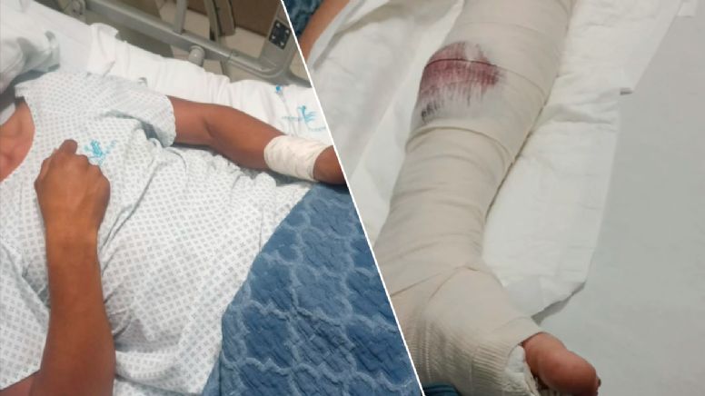 Negligencia médica: Va a clínica para recuperarse de pierna amputada y le fracturan la otra
