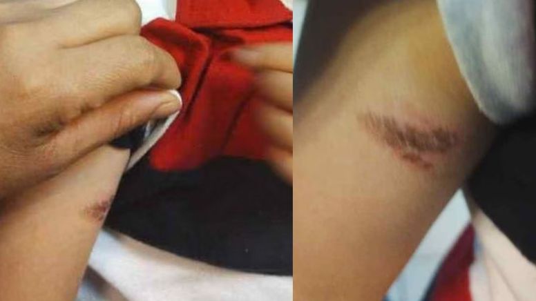 Muestran la lesión que causó que padres golpearan a maestra de kínder: tenía una quemadura
