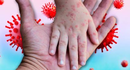 Ya hay contagios en México: 3 personas se infectaron de sarampión tras llegada de viajero enfermo