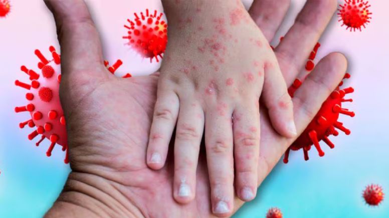 Ya hay contagios en México: 3 personas se infectaron de sarampión tras llegada de viajero enfermo